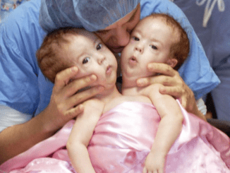 Conjoined Twins Bella And Abby Were Genuinely Associated From Birth, Yet Medical Procedure Changed Everything