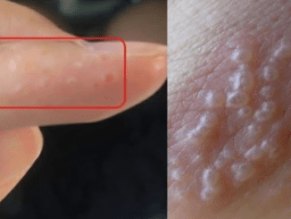 If You Notice Painful Red Bumps, You Might Have Dyshidrotic Eczema