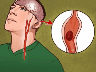 7 Telltale Signs Of A Stroke You Shouldn’t Ignore: A Life-Saving Guide