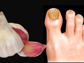 Erase Nail Fungus Naturally: Discover the Power of Garlic