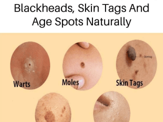 Natural Skin Care: What Can You Try To Remove Age Spots, Moles, Skin Tags, Warts, And Blackheads?