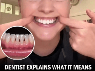 Dentists Explain What Those Black Triangles Are Between Your Teeth