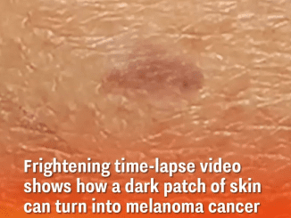 Video Time-Lapse Shows How Dark Patch of Skin Turns Into Melanoma Cancer