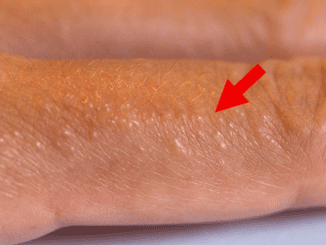 If You See These Painful Red Bumps, You May Have Dyshidrotic Eczema