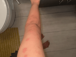 How To Identify 10 Of The Most Common Bug Bites