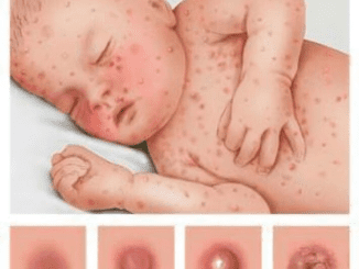 Mom’s Facebook Post Serves as a Reminder Why You Shouldn’t Treat Chickenpox with Ibuprofen