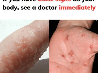 Dyshidrotic (Dyshidrosis) Eczema