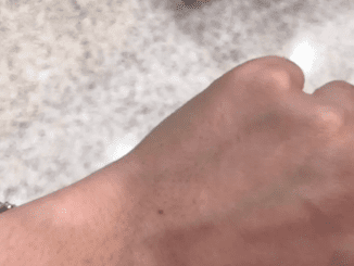 If You Have This Freckle On Your Arm Here’s What It Means