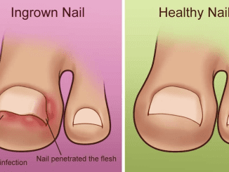 Natural ways to treat ingrown toe nails at home