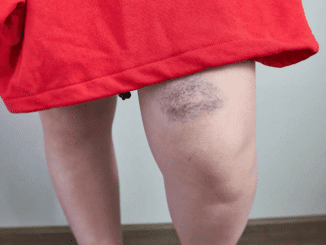 Here’s why some people bruise more easily than others