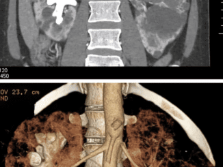 What Are Staghorn Kidney Stones? (Symptoms, Causes, and Treatment) 