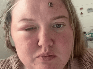 My week-long headache turned out to be a brain tumor — I had one unusual sign