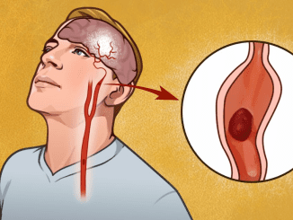 7 early warning signs of stroke everyone should know