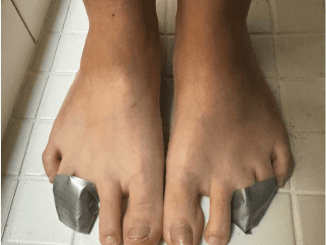 Lady tapes her 3rd and 4th toes together for this brilliant reason