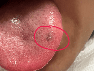 Should I be worried about this black spot on my tongue? What should I do?