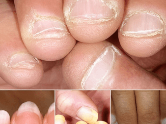 Doctor Reveals 7 Health Conditions You Can Spot By Just Checking Your Nails…