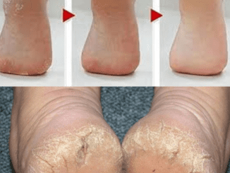 Wrap Your Feet In Bread And Saran Wrap To Naturally Remove Yucky Corns And Calluses…