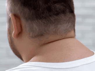 Got a buffalo hump on your neck. Here’s what it meansand what you should do