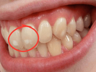 If your teeth have white spots like this, go see a doctor immediately