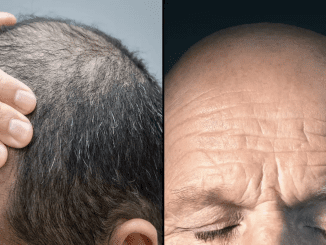 Experts reveal common lifestyle factor that could be making you bald