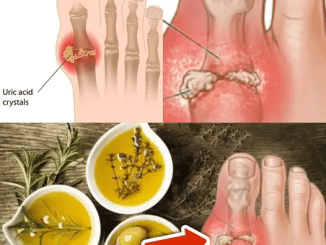 Easy Ways to Remove Excess Uric Acid That Easier Than You Think…