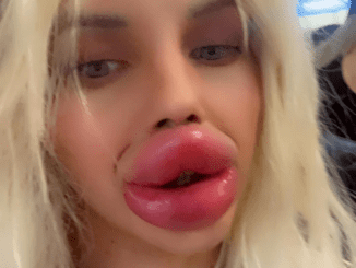 “I’m More Lips Than Human”, A Woman Struggles to Eat Due to Her Huge Lips but is Determined to Make Them Even Bigger