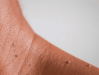 10 natural ways of getting rid of skin tags